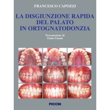 La disgiunzione rapida del palato in ortognatodonzia. Aspetti concettuali ed operatività  clinica