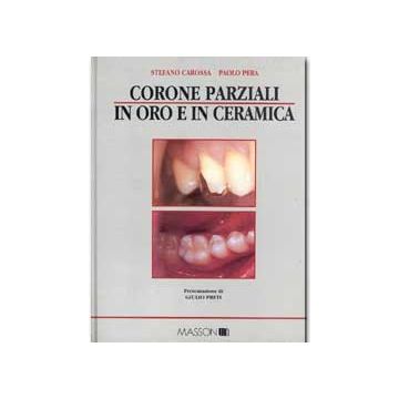 Corone parziali in oro e in ceramica