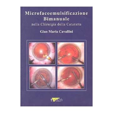 Microfacoemulsificazione Bimanuale nella chirurgia della cataratta