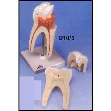 Dente molare inferiore a due radici, con carie, in 2 parti