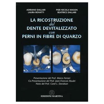 La ricostruzione del dente devitalizzato con perni in fibre di quarzo
