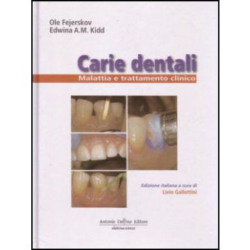 CARIE DENTALI. Malattia e Trattamento Clinico