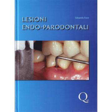 Lesioni Endo - Parodontali