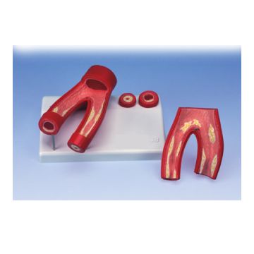 Modello di arteriosclerosi, con sezione delle arterie (in 2 parti)