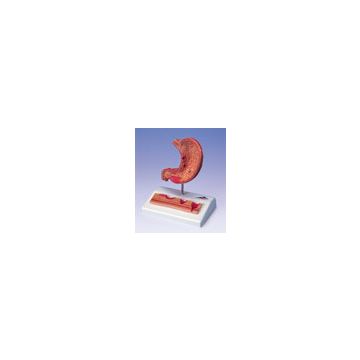 Stomaco con ulcere gastriche