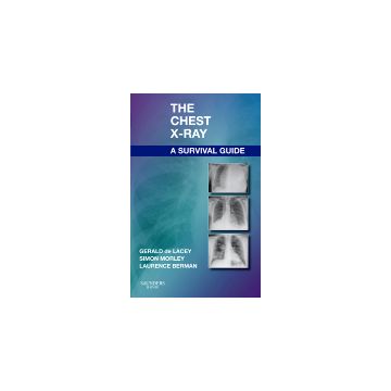 The Chest X-Ray: A Survival Guide