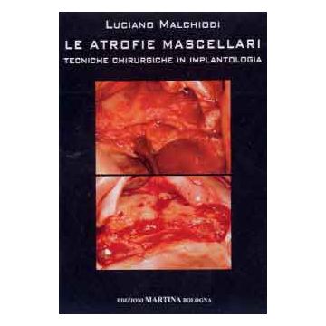 Le atrofie mascellari - Tecniche chirurgiche in implantologia