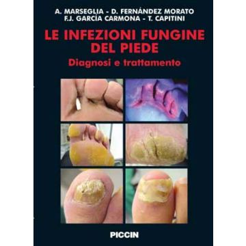 Le Infezioni Fungine del Piede - Diagnosi e trattamento
