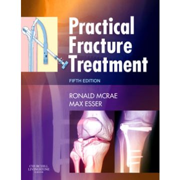 Practical Fracture Treatment, 5th Edition
