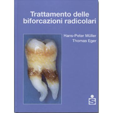 Trattamento delle biforcazioni radicolari