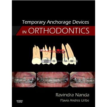 Temporary Anchorage Devices in Orthodontics