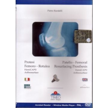 Protesi Femoro Rotulea  - Patello femoral resurfacing prosthesis.  DVD-ROM