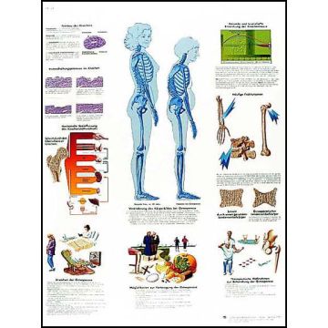 POSTER - Osteoporosi (Laminata)