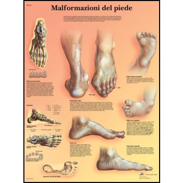 POSTER - Malformazioni di piede (in carta)