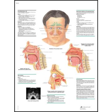 POSTER - Rinite e sinusite (In carta)