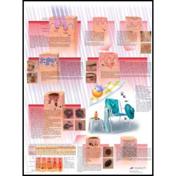 POSTER - Cancro della pelle (In carta)