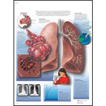POSTER - BPCO Broncopneumopatia cronia ostruttiva (Laminata)