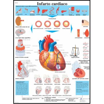 POSTER - Infarto cardiaco (In carta)