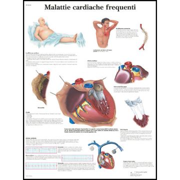 POSTER - Malattie cardiache frequenti (In carta)