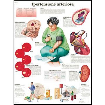POSTER - Ipertensione arteriosa (Laminata)