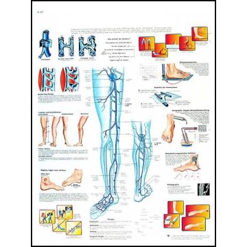 POSTER - Vene varicose (Laminata)