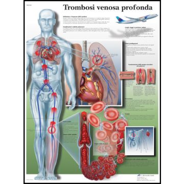 POSTER - Trombosi venosa profonda (In carta)