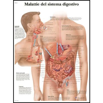 POSTER - Malattie del sistema digestivo