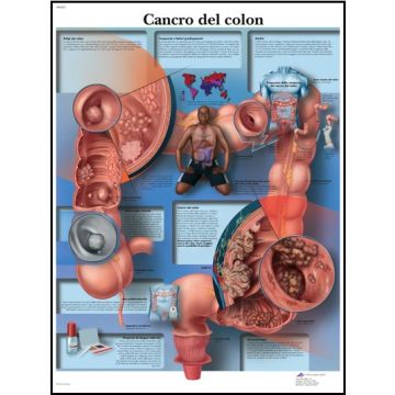 POSTER - Cancro del colon (Laminata)