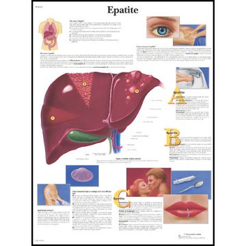 POSTER - Epatite (In carta)
