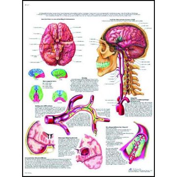 POSTER - Colpo apoplettico (In carta)