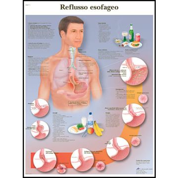 POSTER - Reflusso esofageo (Laminata)