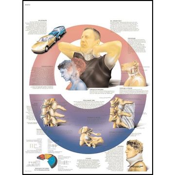 POSTER - Lesioni traumatiche della colonna cervicale (In carta)