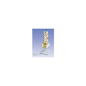 Colonna vertebrale lombare con ernia del disco dorsolaterale