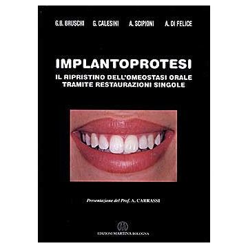 Implantoprotesi - Il ripristino dell’omeostasi orale tramite restaurazioni singole  