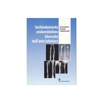Inchiodamento endomidollare bloccato dell'arto inferiore