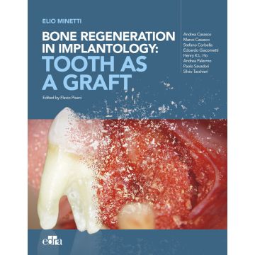 Bone regeneration in implantology: tooth as a graft [Elio Minetti - Edra Masson]