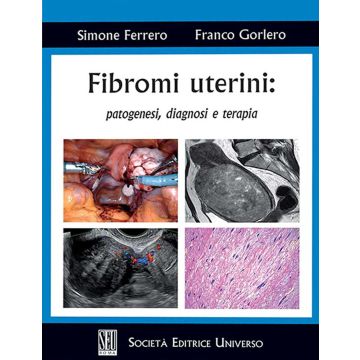 Fibromi uterini: patogenesi, diagnosi e terapia