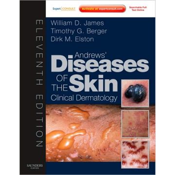 Andrews' Diseases of the Skin, 11th Edition - Clinical Dermatology - Expert Consult - Online and Print