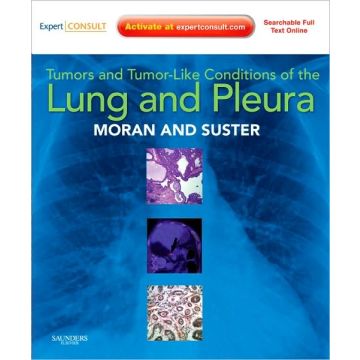 Tumors and Tumor-like Conditions of the Lung and Pleura Expert Consult: Online and Print