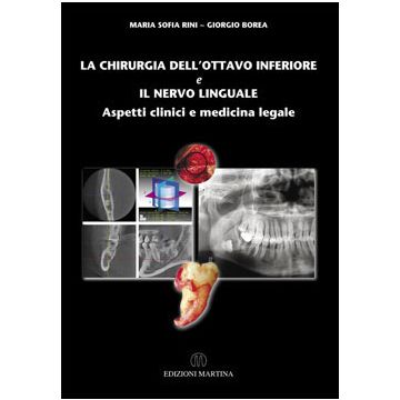 LA CHIRURGIA DELL’OTTAVO INFERIORE e IL NERVO LINGUALE - Aspetti clinici e medicina legale  