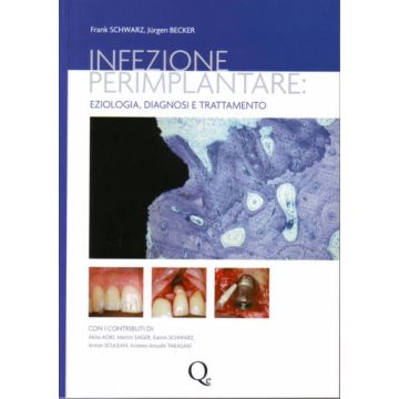 Infezione Perimplantare: eziologia, diagnosi e trattamento