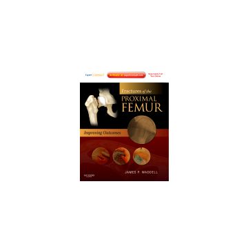 Fractures of the Proximal Femur: Improving Outcomes - Expert Consult: Online and Print